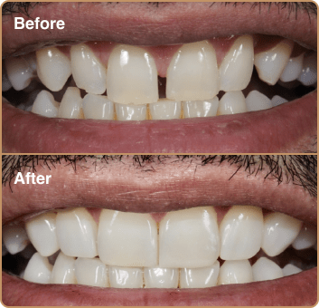 composite-before-after-1