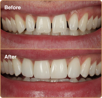 dental-treatment-before-after-img-6 Composite bonding London – filling gaps in teeth for a seamless smile