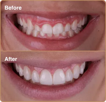 composite-before-after-2 before and after results - composite bonding
