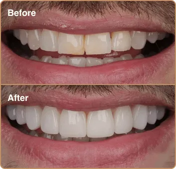 composite-before-after-4