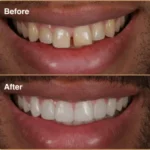before and after results - composite bonding