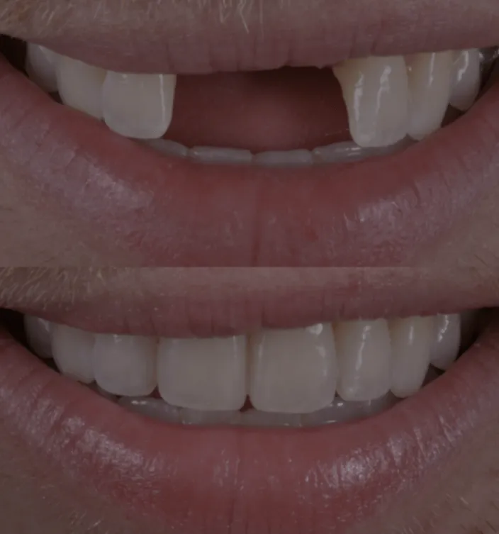 dental-implants-img