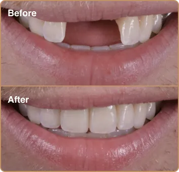 dental_before_after_1 dental_before_after_1