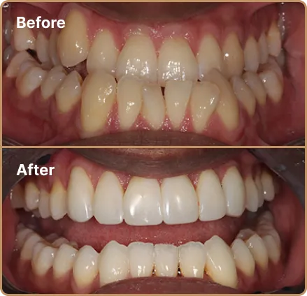 Invisalign Manchester