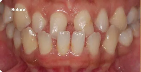 gap-teeth-img_before