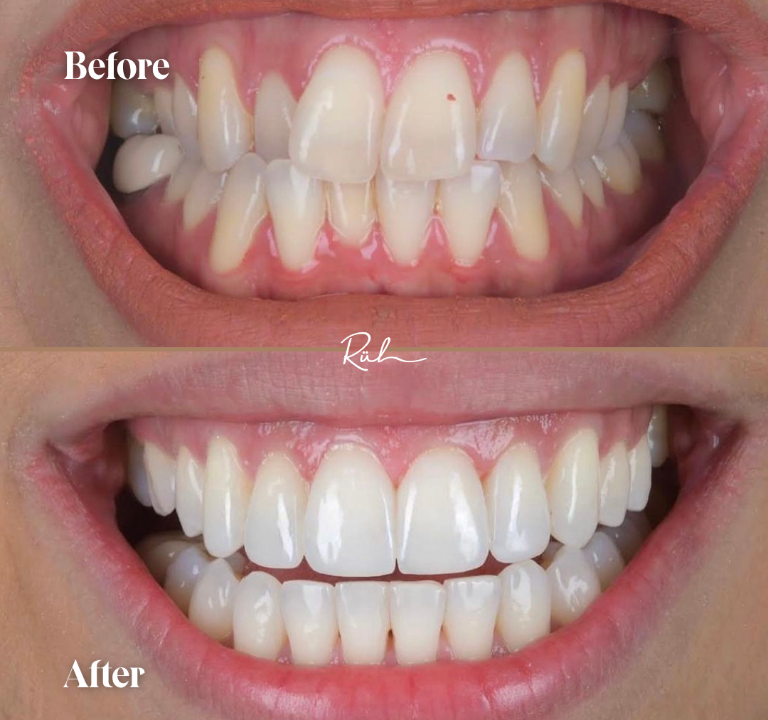 Composit-Bonding-Invisalign