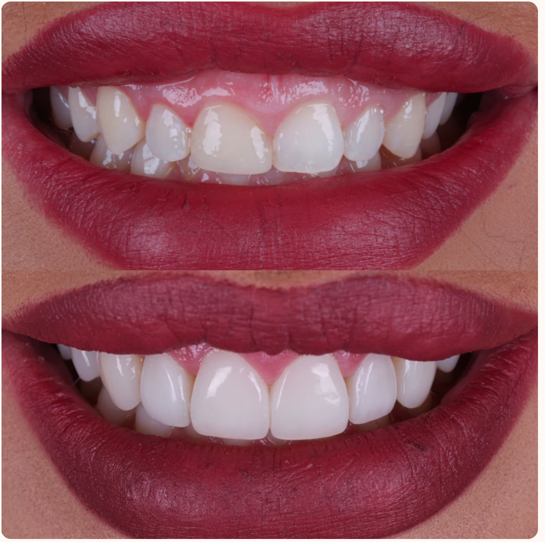 gummy-smile