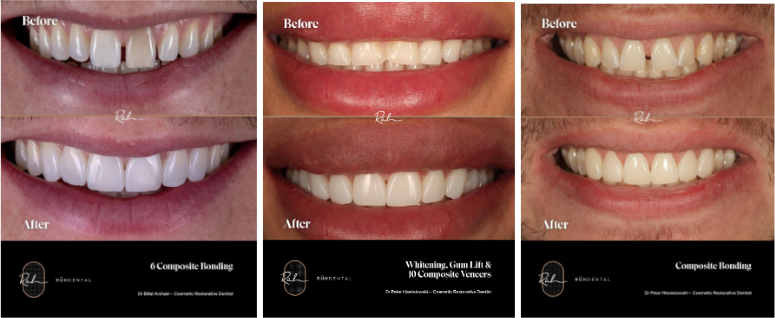 Teeth Whitening