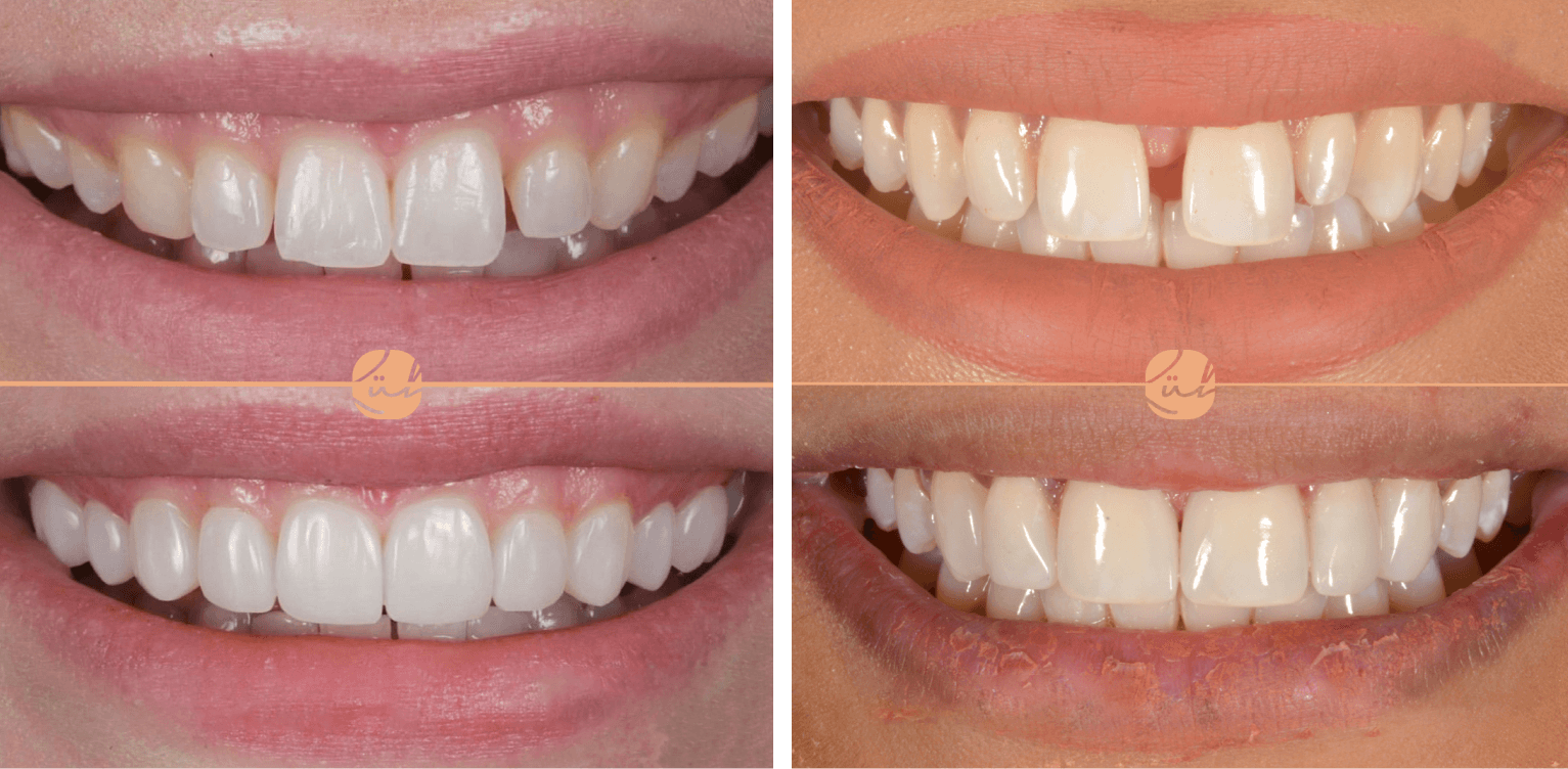 Composite Bonding [GUIDE]: Fix Teeth Stains, Gaps, Shape & More