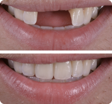 dental-implants-before-after-374x348