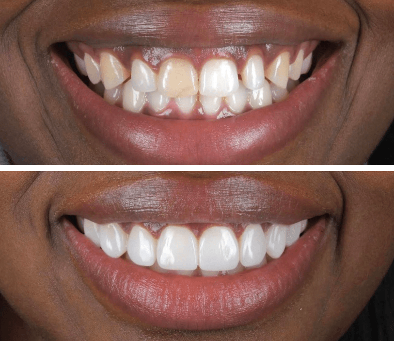 Composite Bonding for discoloured teeth
