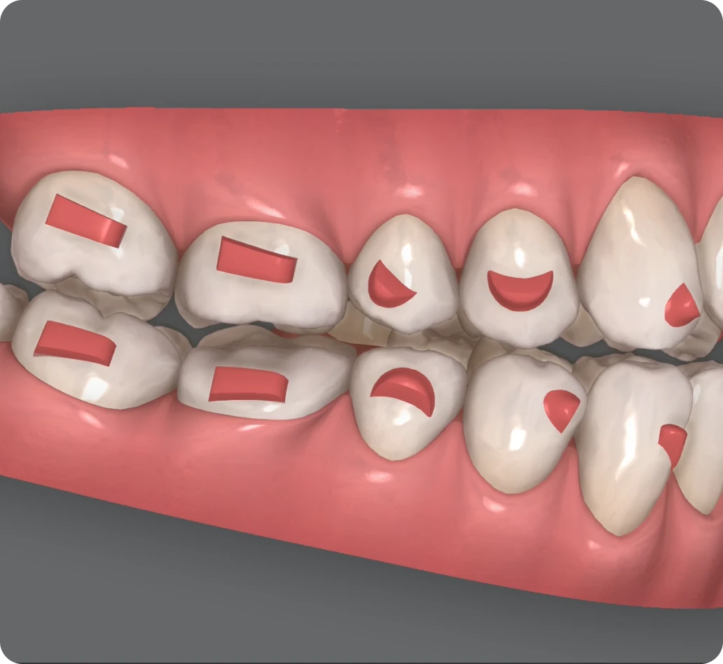 Invisalign Clincheck