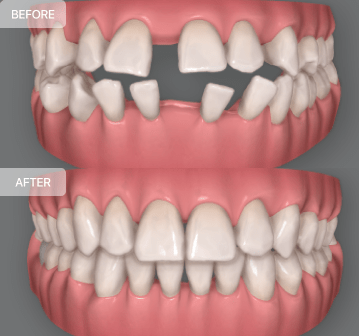 Invisalign gap teeth