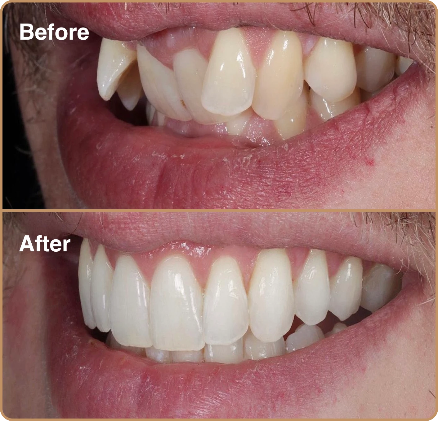 Crooked front teeth Invisalign before and after images