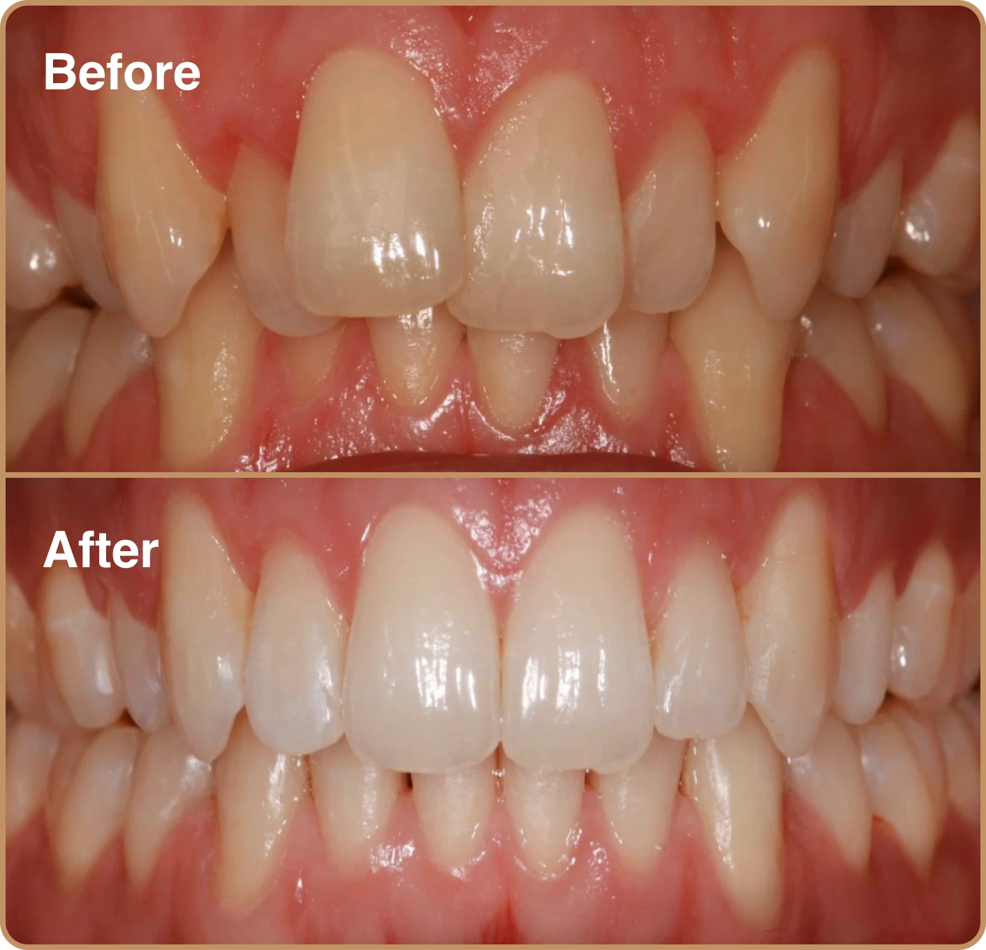 Misaligned teeth Invisalign before and after