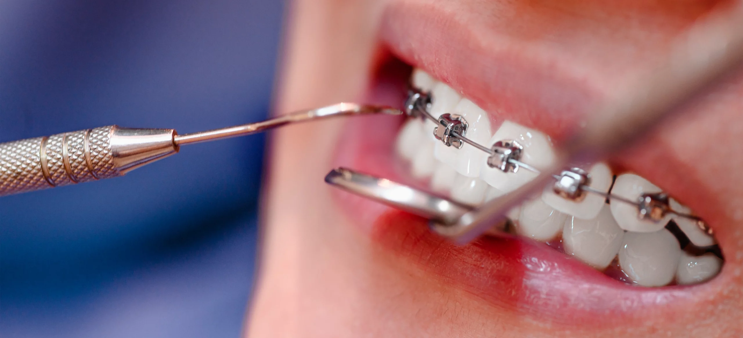 Braces Vs. Invisalign Cost  Oral health care, Natural oral care, Oral care