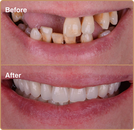 Dental implants before and after