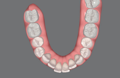 Invisalign Moderate