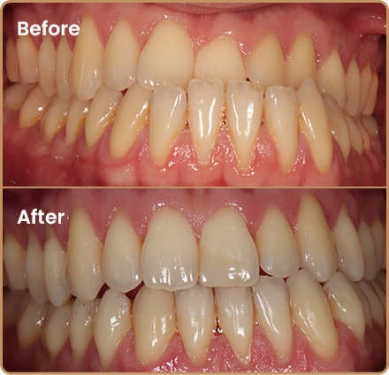 Invisalign before and after underbite