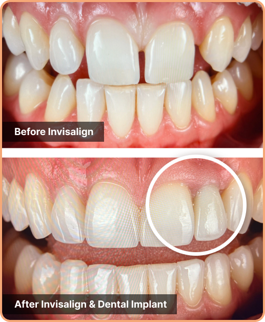 Invisalign and dental implants before and after