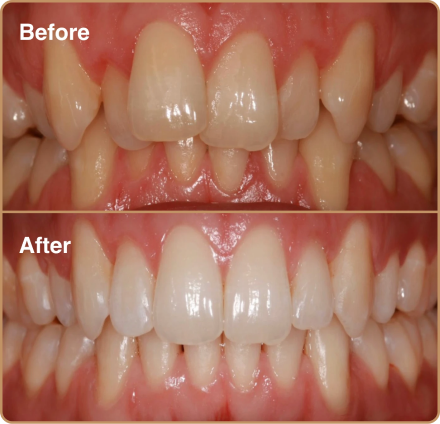 Invisalign for misaligned teeth