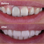 Porcelain veneers before and after