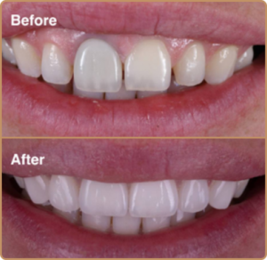 Porcelain veneers before and after