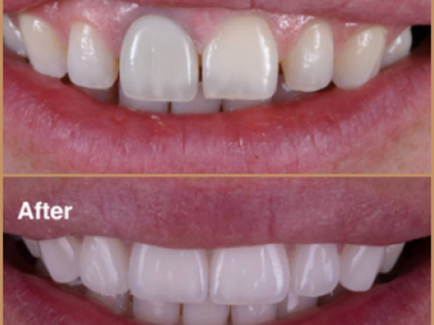 Porcelain veneers before and after