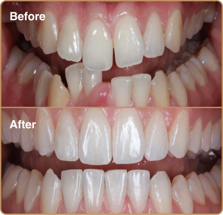 Invisalign for crooked bottom teeth