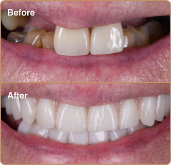 Full mouth implants before and after