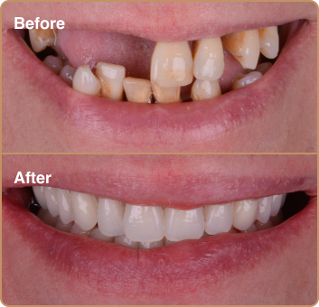 Same day smile makeover dental implants before and after