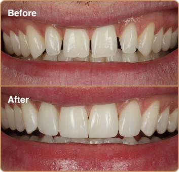 Gappy teeth before and after
