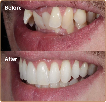 Invisalign for crooked front teeth