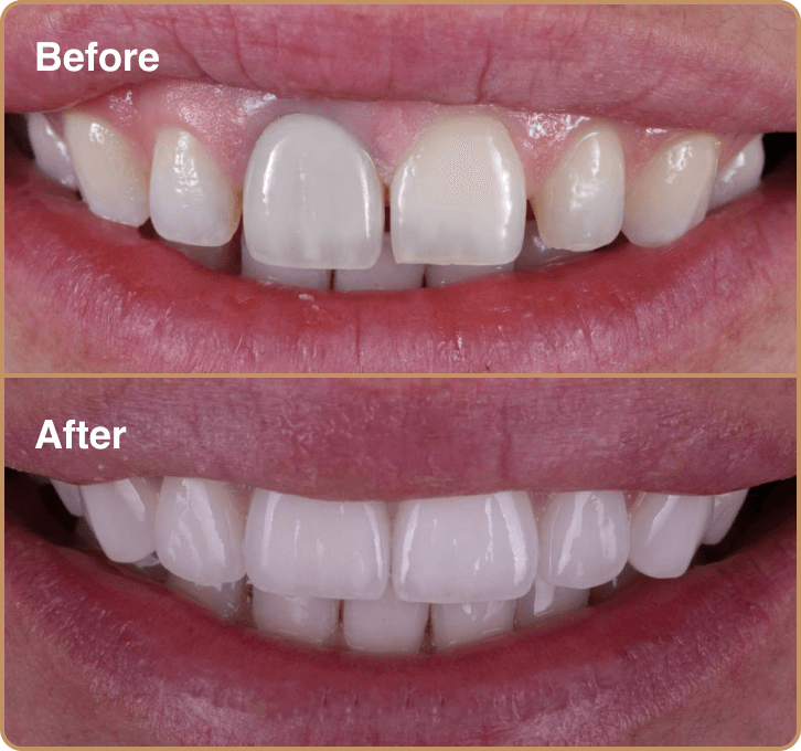 Discoloured front tooth before and after porcelain veneers