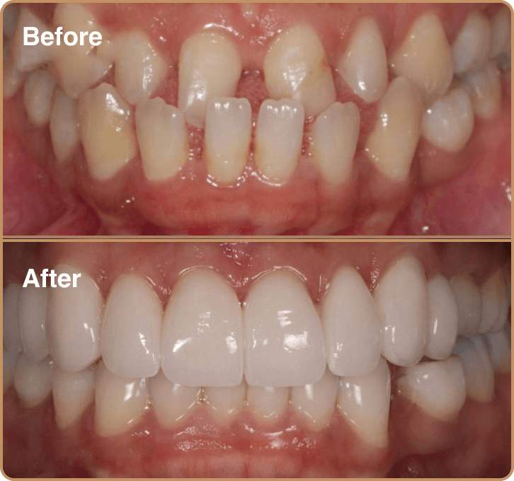 Underbite correction with Invisalign and porcelain veneers for gappy teeth