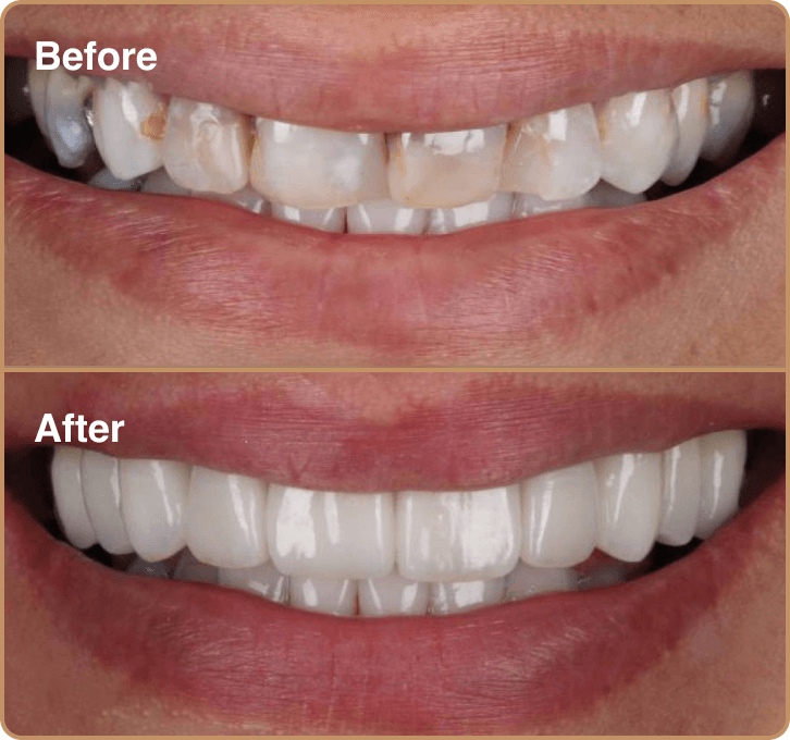 Stained teeth porcelain veneers before and after