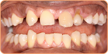 Invisalign with missing teeth