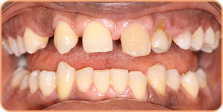 Invisalign for gappy teeth