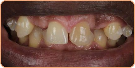 Invisalign and dental bridges