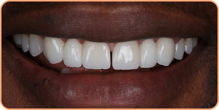 Invisalign and porcelain veneers