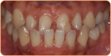 Invisalign underbite before and after