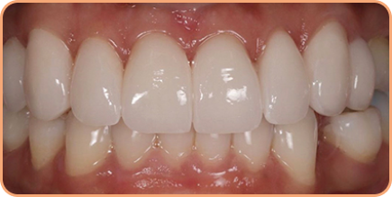 Invisalign and Porcelain veneers