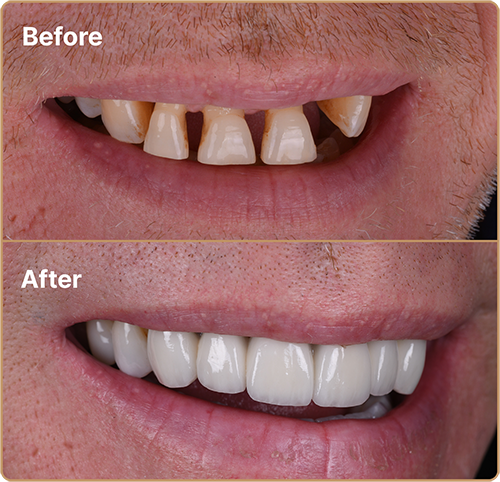 Porcelain Veneers for broken teeth