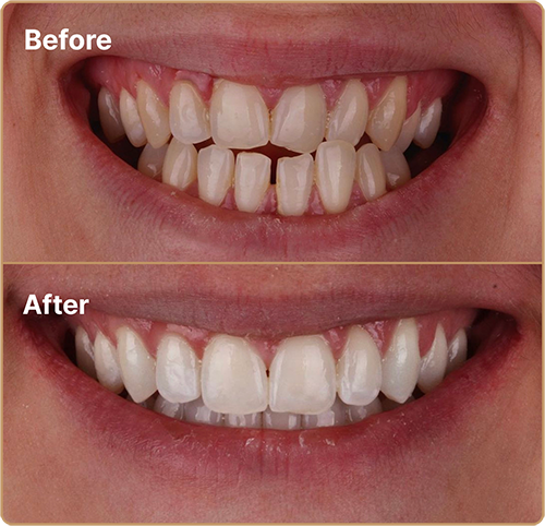 Invisalign before and after to fix crossbite