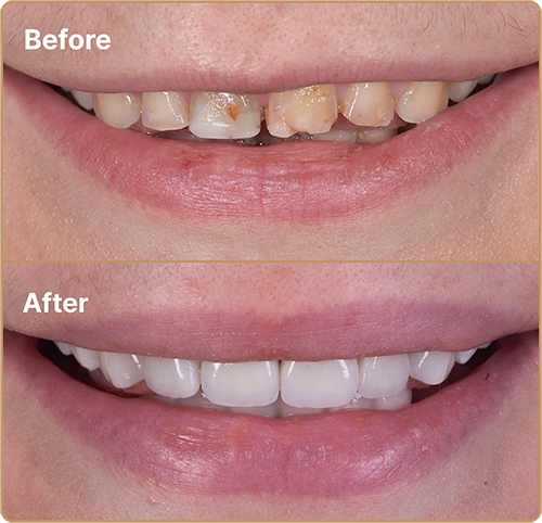 Porcelain Veneers before and after for discoloured teeth