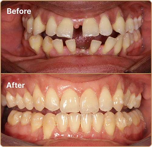 Invisalign gappy teeth before and after