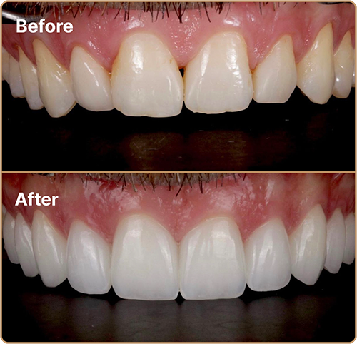 Porcelain veneers for small teeth before and after