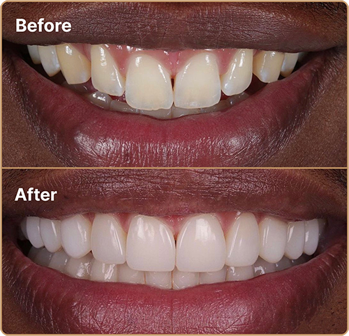 small teeth bonding before and after