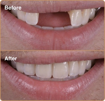 dental implant before and after