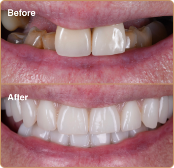 dental implant before and after